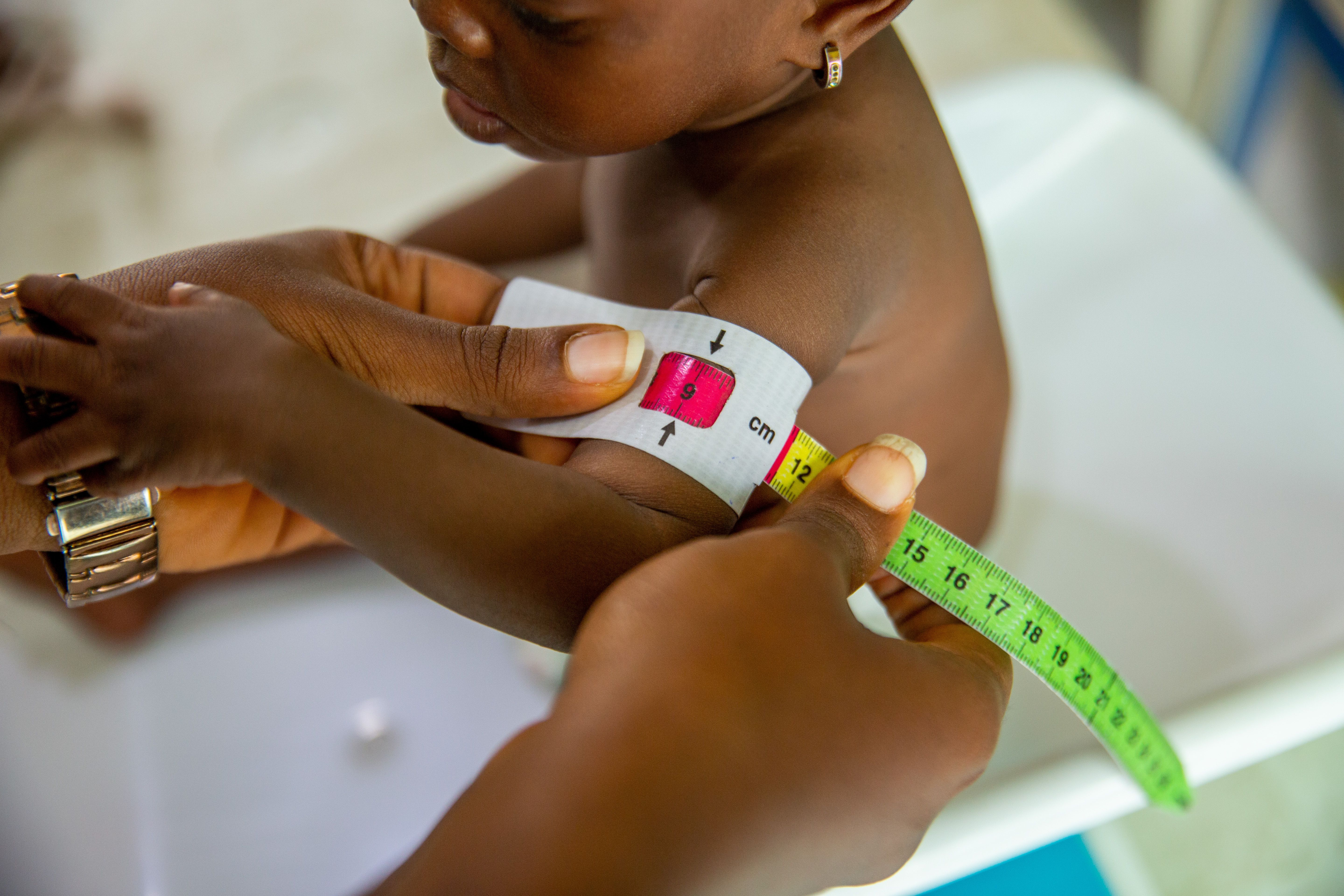 Noma bedroht mangelernährte Kinder im Norden Nigerias